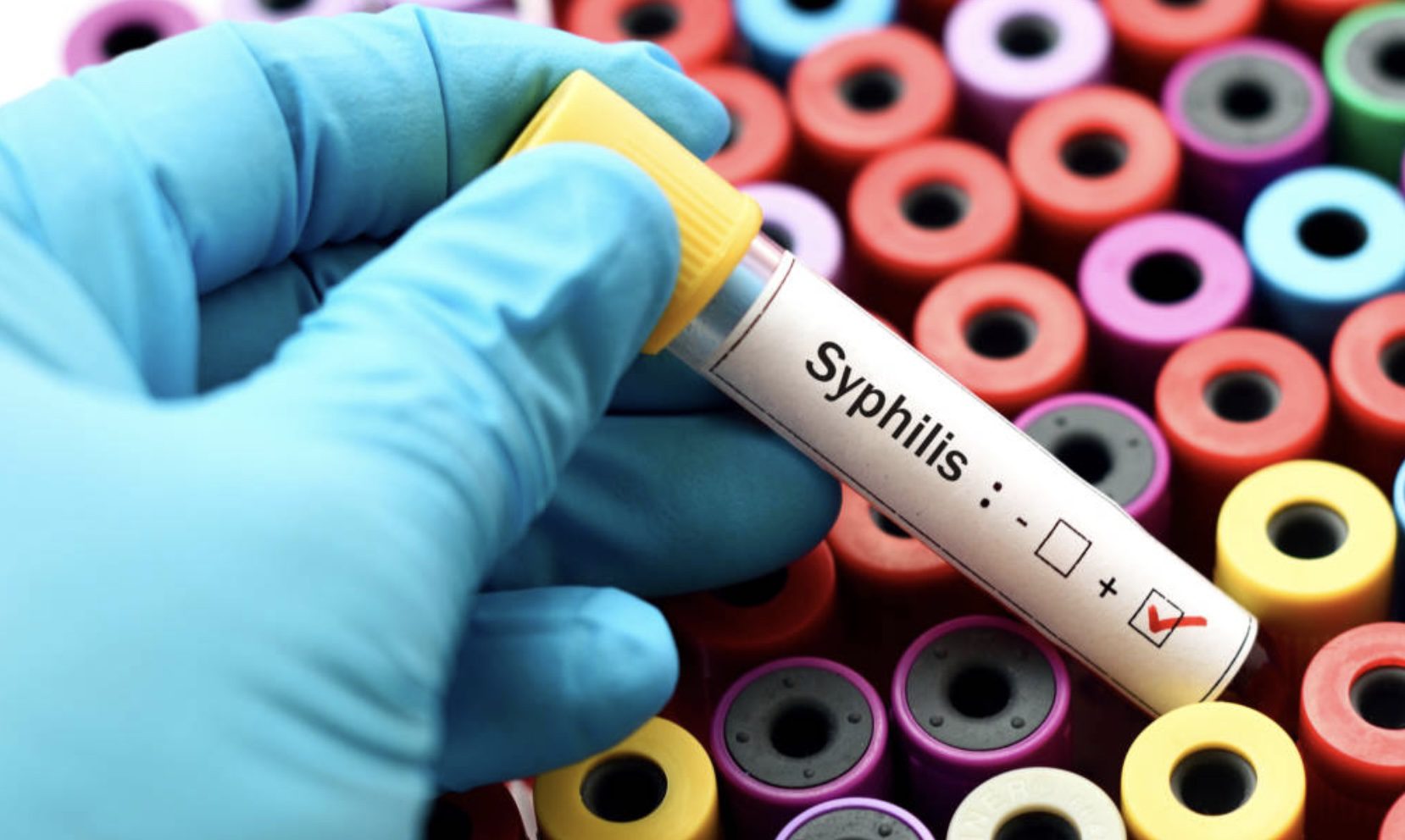 Health Officials Take Action as Syphilis Cases in Missouri Reach Record Highs
