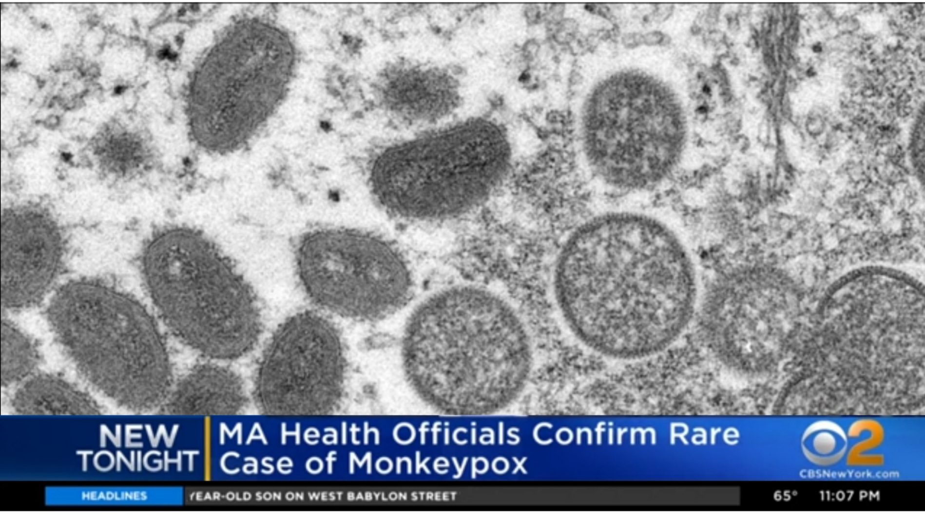 Here We Go Again: Biden Administration Buys Millions of Doses of Monkeypox Vaccine After Case is Confirmed in Massachusetts – Health Officials Currently Investigating Second Potential Case in NYC