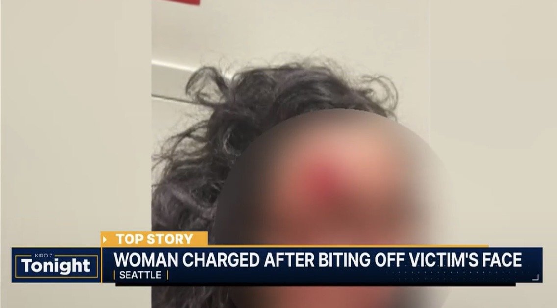 HORROR: ‘Zombie’ Attacker Bites Chunk of Woman’s Face Off in Seattle in Racially Motivated Attack