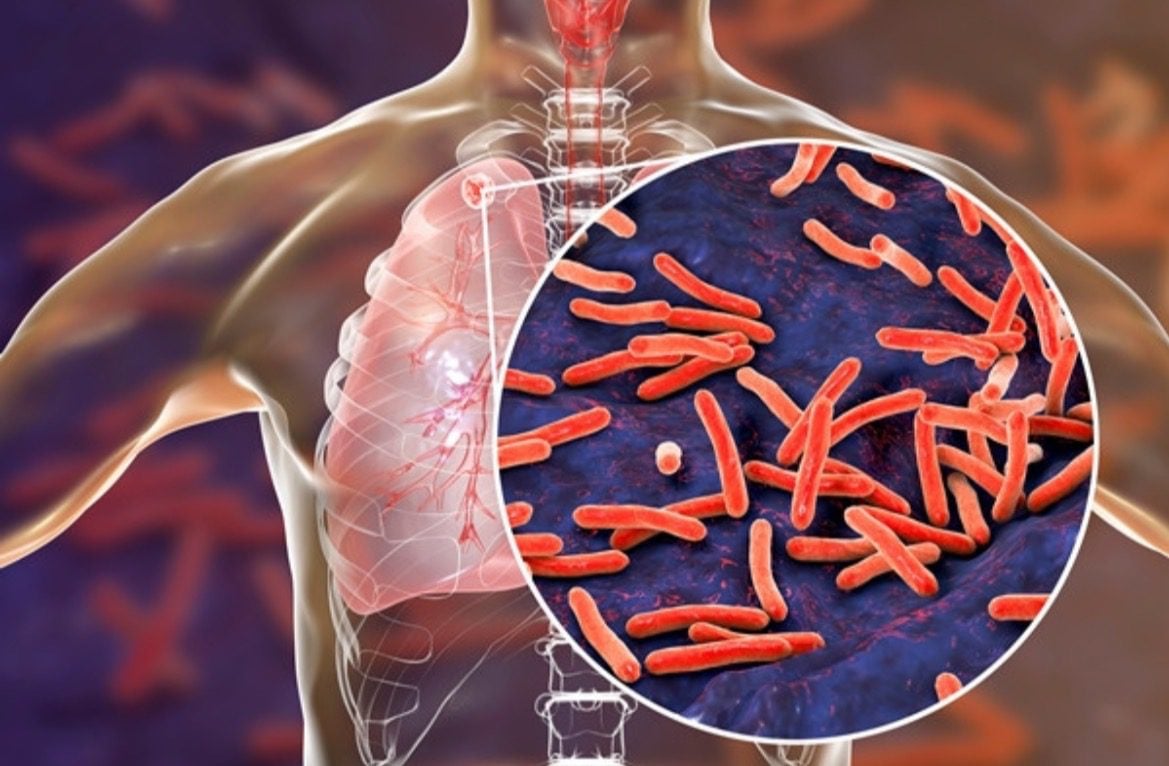 Woman Arrested For Refusing Treatment For Tuberculosis For More Than a Year