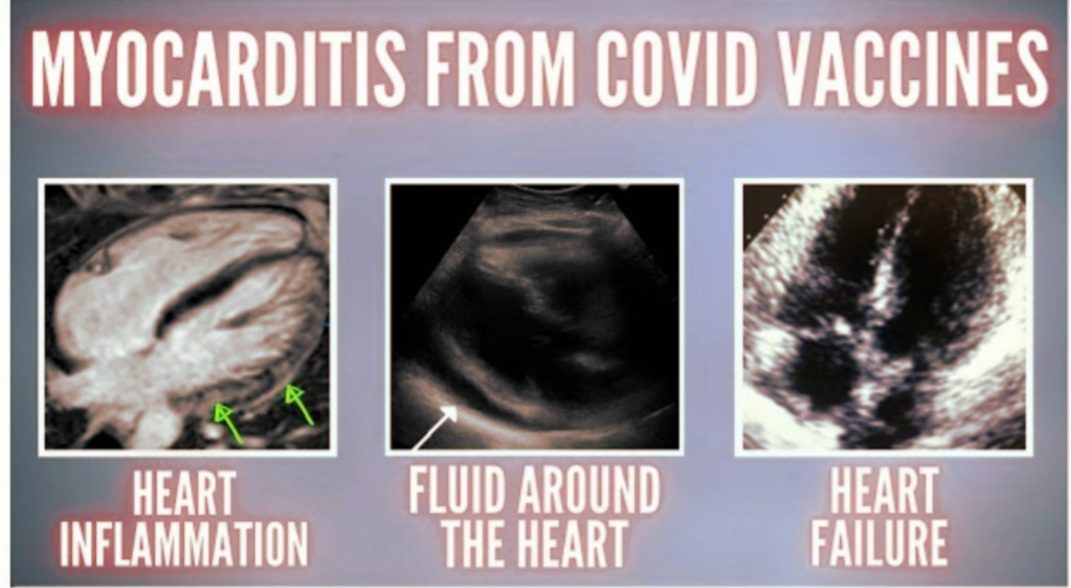 New Study Shows 1 in 1000 Develop Heart Inflammation After Covid Vaccination; Myocarditis and Other Related Heart Conditions Have Increased Death Rate Within 5 Years | The Gateway Pundit | by Julian Conradson