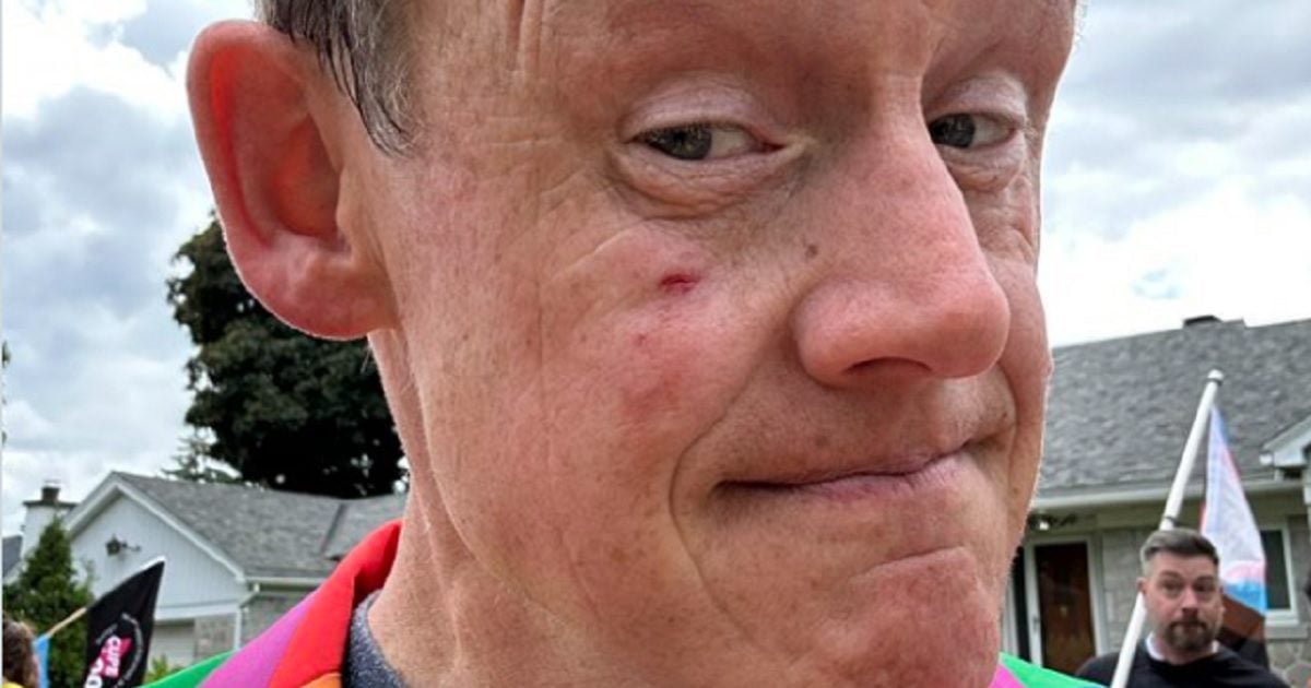 Joel Harden, a member of Canada's New Democratic Party, displays an abrasion on his face where he initially suggested he'd been punched during a demonstration.