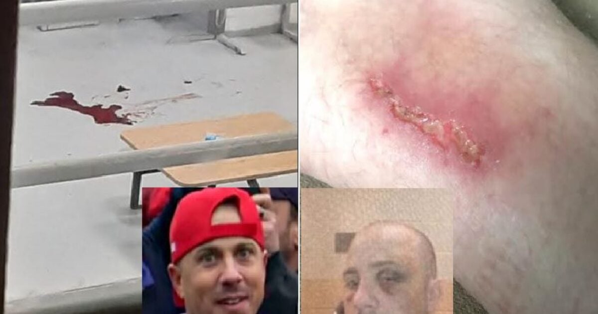 EXCLUSIVE: Images Obtained Following J6 Political Prisoner Ryan Samsel’s Brutal Beating by Guards and Following Police Abuse with Shackles – AUDIO | The Gateway Pundit | by Jim Hoft